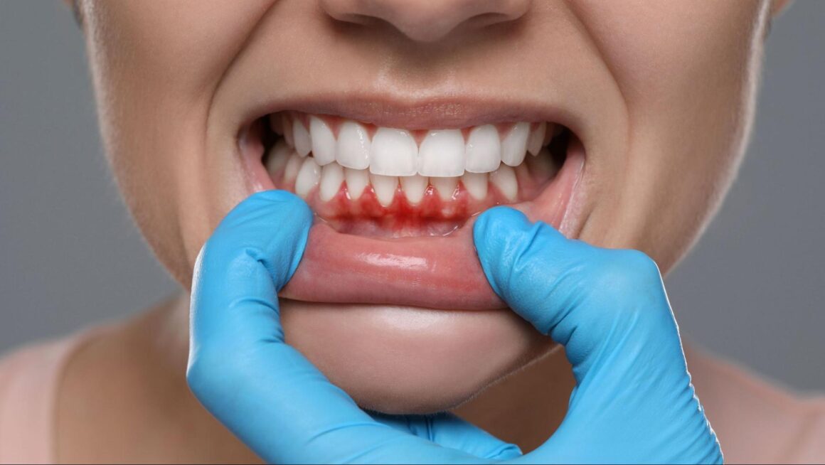 4 gum disease warning signs